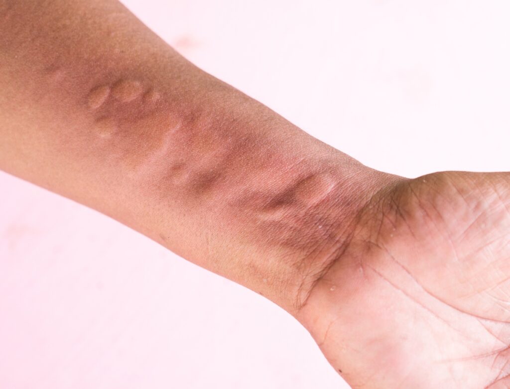 Identifying Severe Allergic Reactions: Symptoms and Precautions